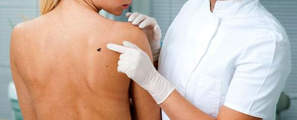 Câncer de pele corresponde a 30% de todos os tumores malignos registrados no Brasil.