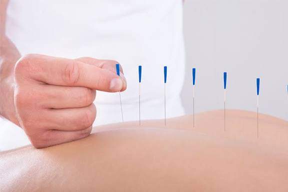 Acupuntura passa a ser profissão regulamentada no Brasil com nova lei federal